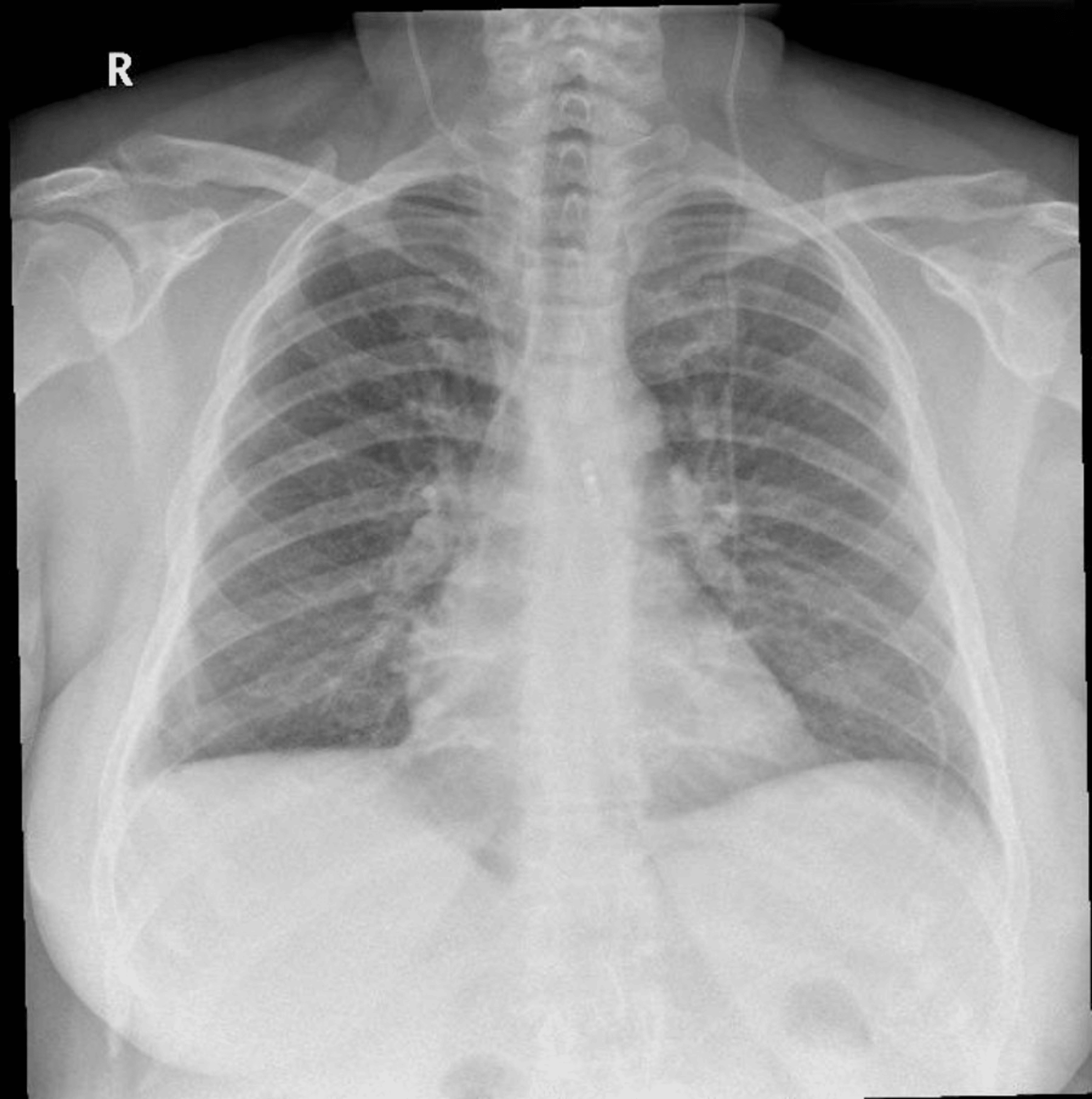 Cureus | a rare case of extraction of ventriculoperitoneal shunt from