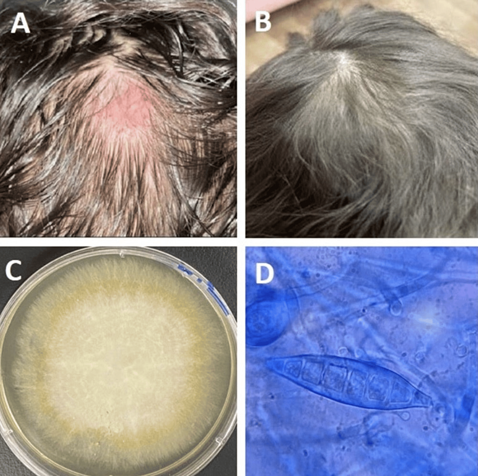 Tinea capitis in a 74-year-old woman. Clinical images a Before