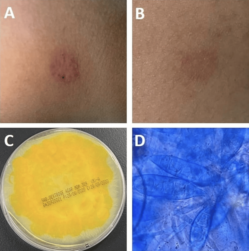 Cureus Microsporum Gypseum Infection Among Two Related Families With