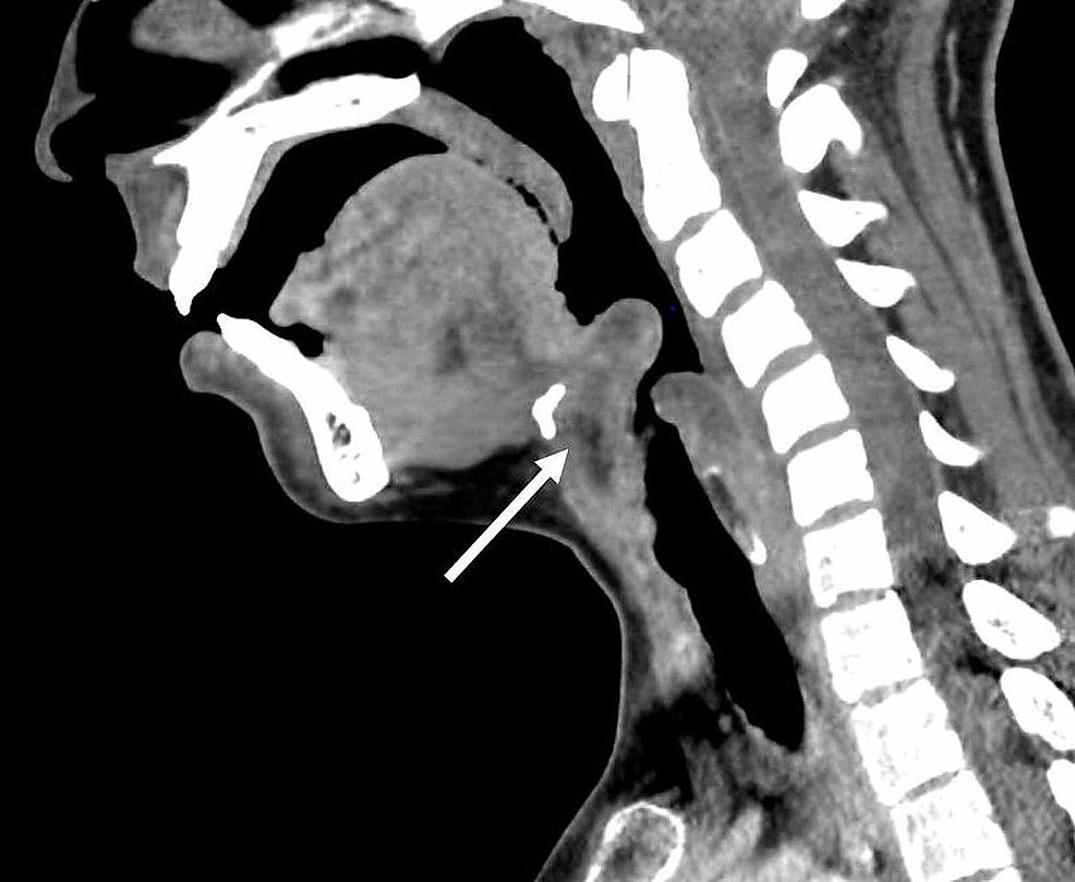 Cureus | Airway Management for an Adult Epiglottic Abscess