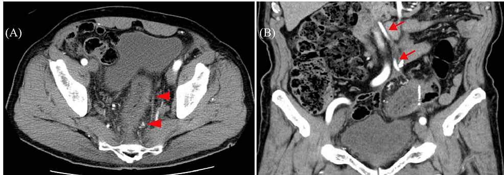 cureus-venous-congestive-ischemic-colitis-after-sigmoid-colectomy-a