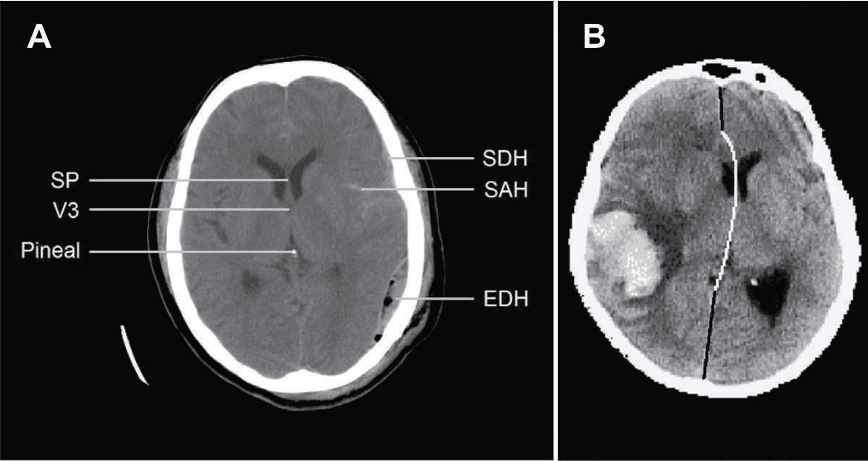 Application of Transcranial Sonography for the Assessment of Brain ...