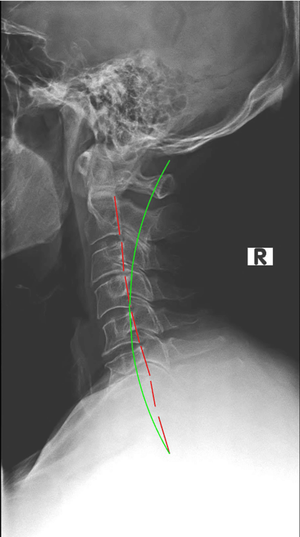 Cureus, Chronic Widespread Spinal Pain (CWSP) Alleviated With Chiropractic  Biophysics®: A Case Report With Three-Year Follow-Up