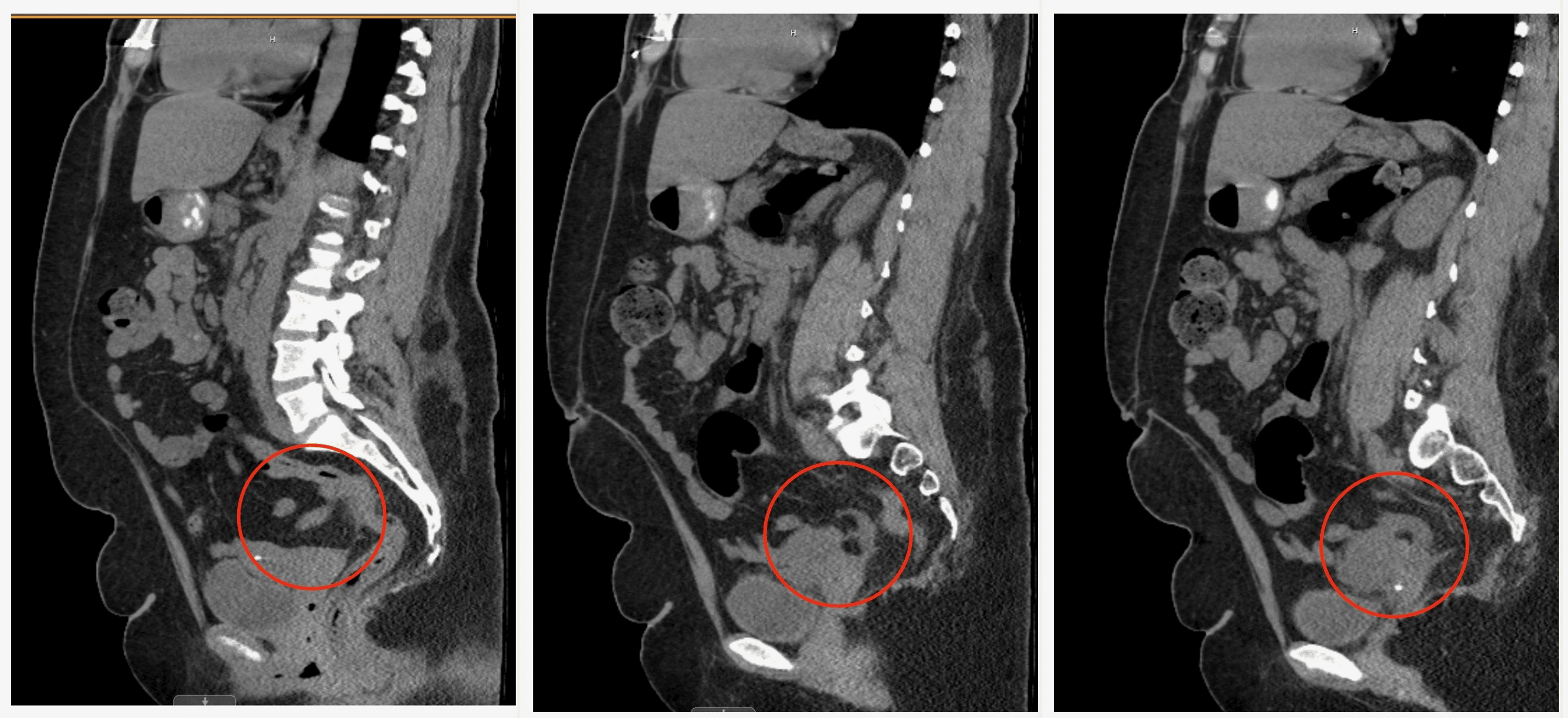 A Case Report of Perforated Appendix Vermiform Attached to the Left
