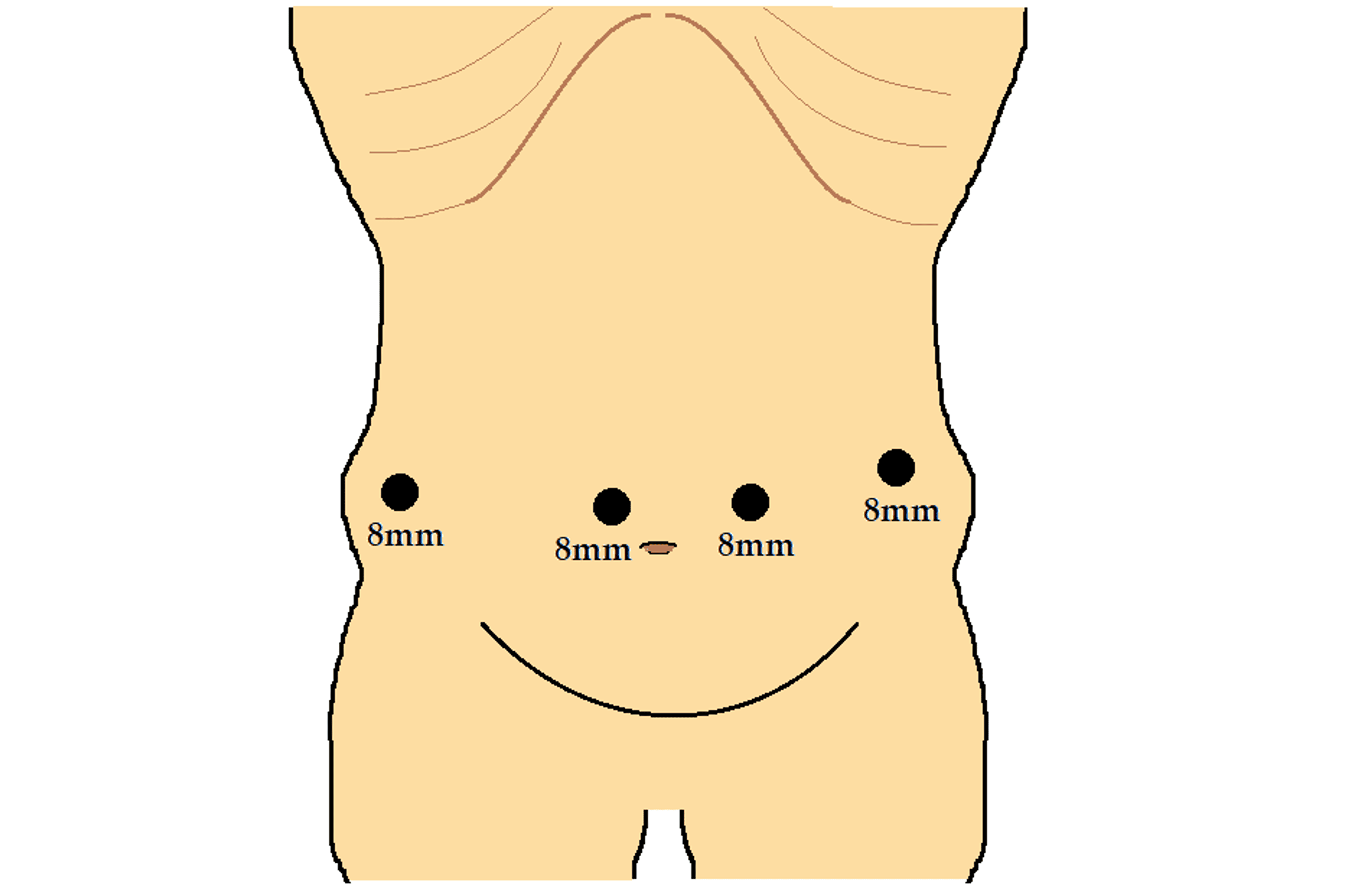 Cureus Robotic Cholecystectomy Remains Safe and Effective After