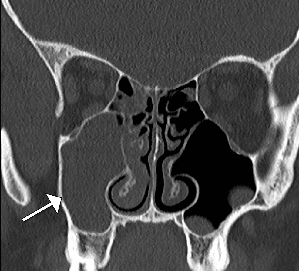 Subdural Empyema in Pediatric Bacterial Meningitis: A Case Report | Cureus