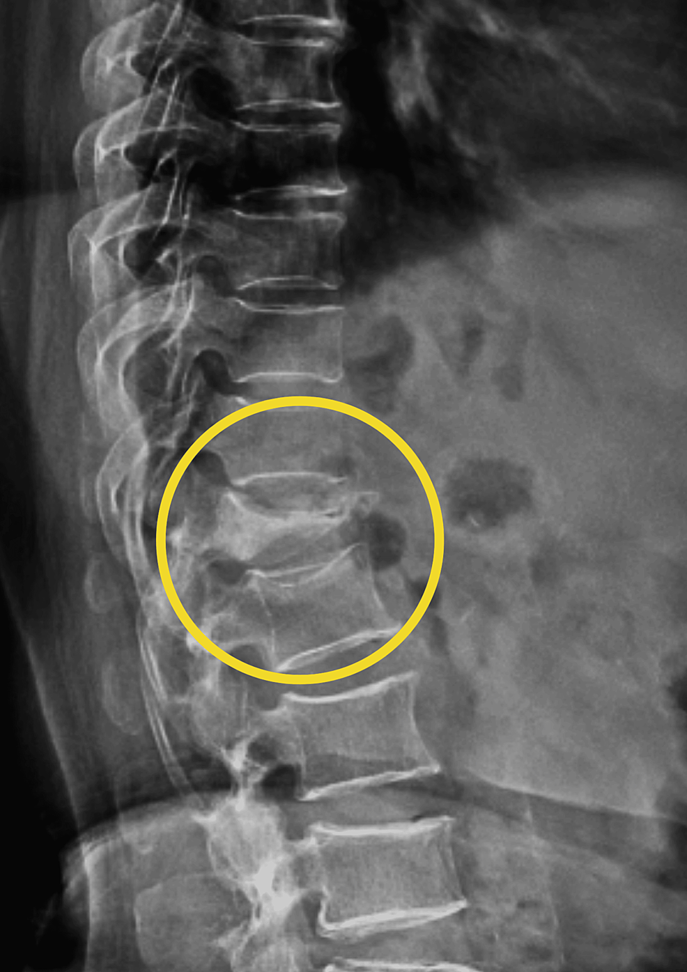 A lumbar compression fracture at L4 treated with a vertebral body