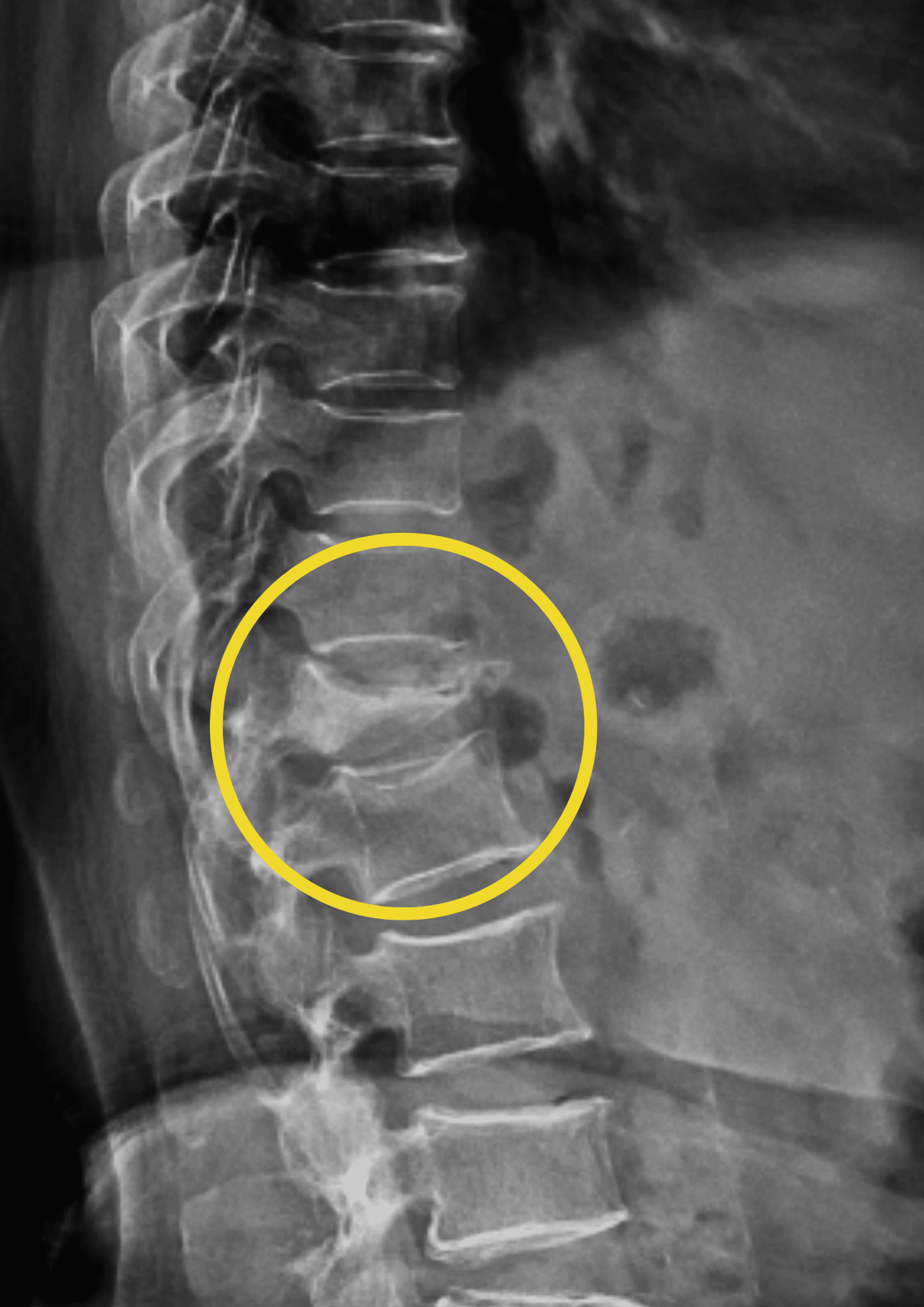 Rehabilitation of a Patient With D12 Wedge Compression Fracture and