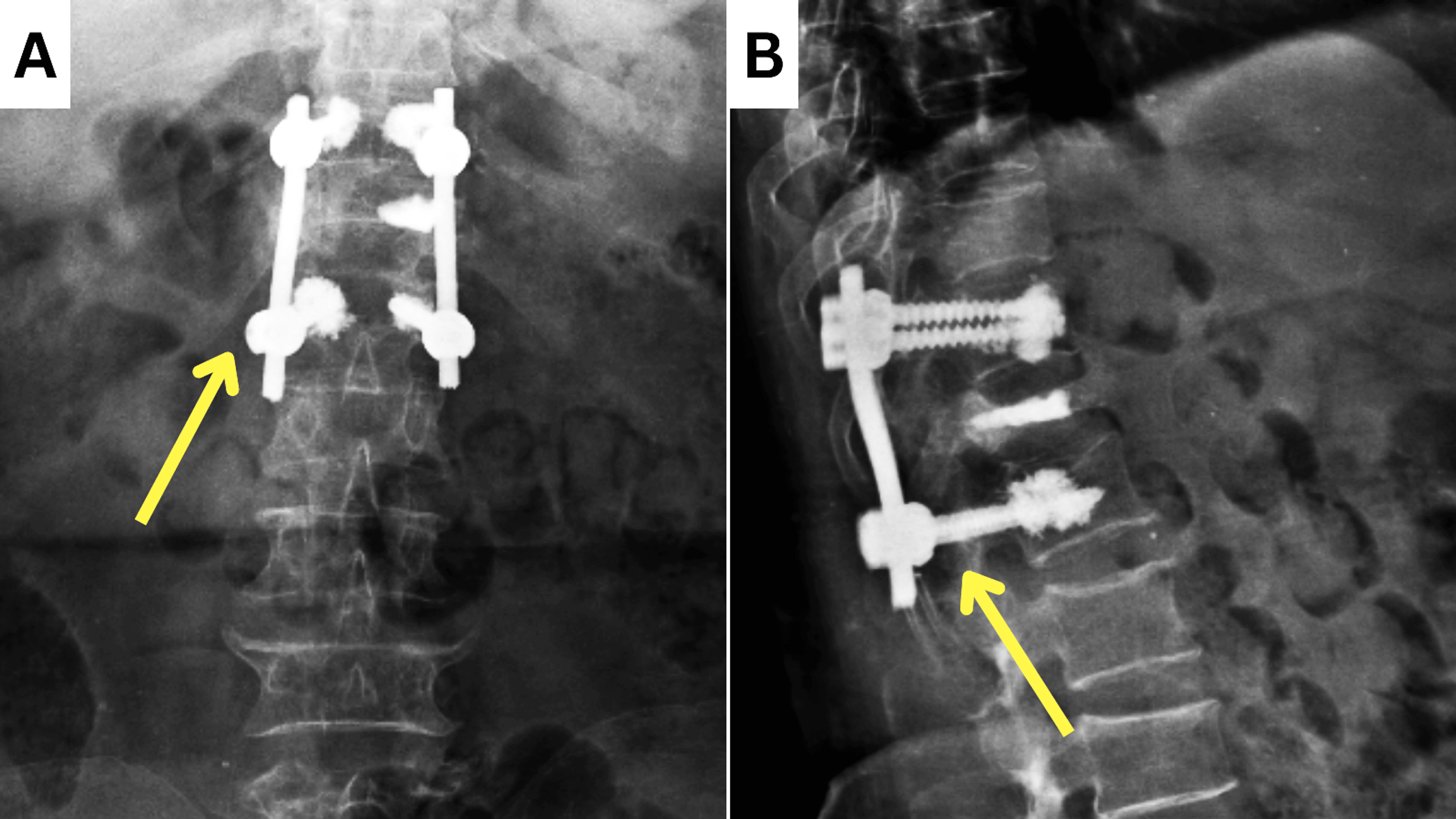 Rehabilitation of a Patient With D12 Wedge Compression Fracture and