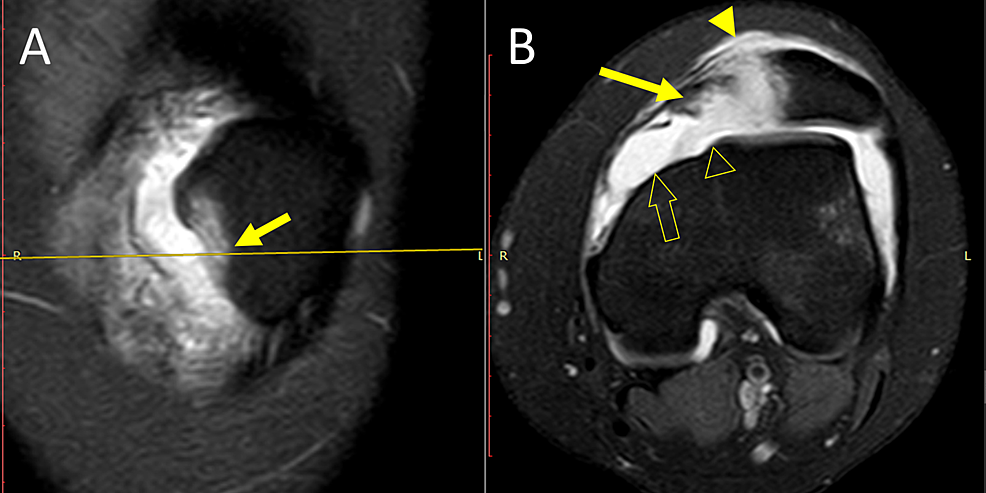 Cureus | Isolated Avulsion Fracture of Patellar Attachment of Medial ...