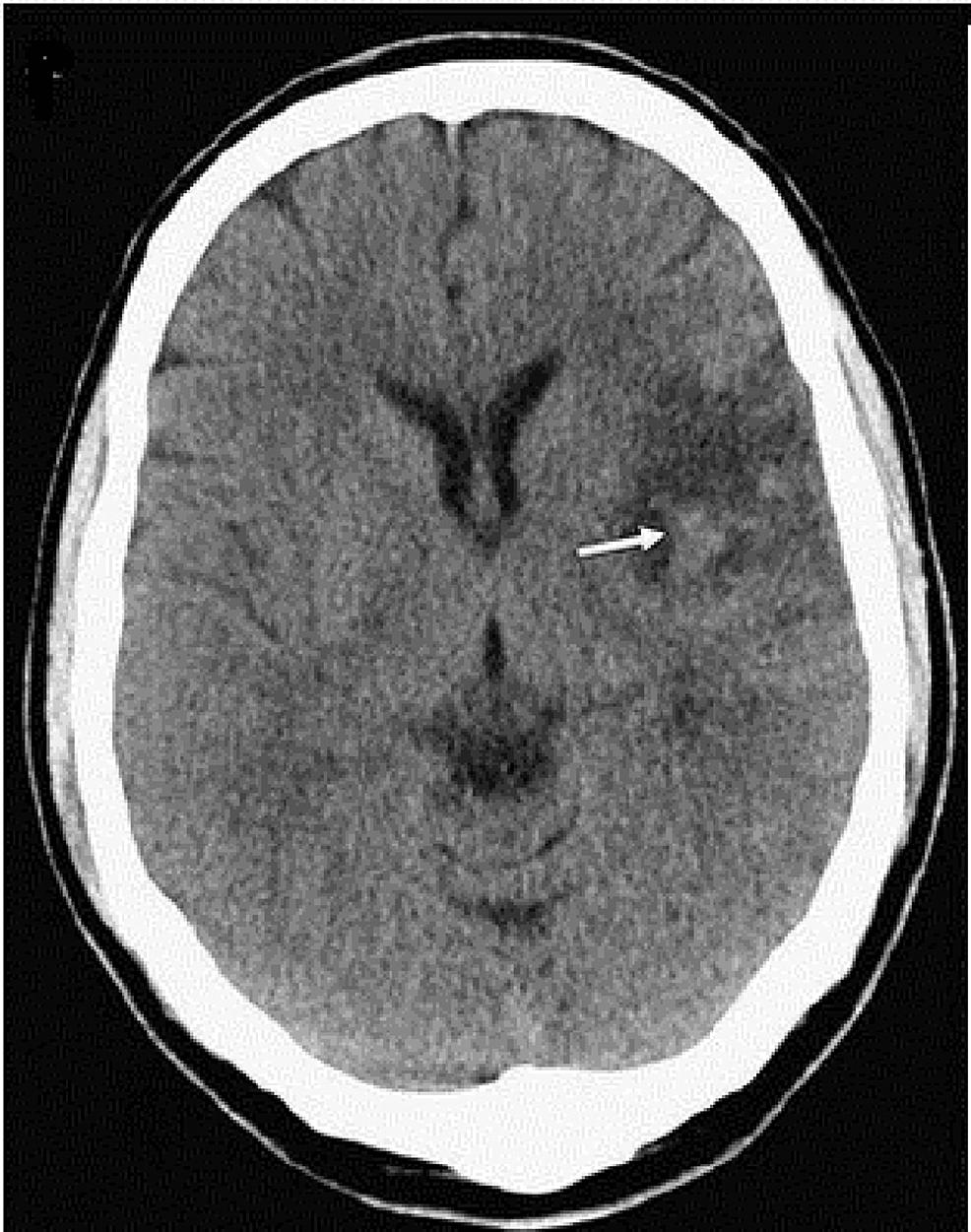 Late Presentation of β-Thalassemia Major Patient With Left Hemiparesis ...