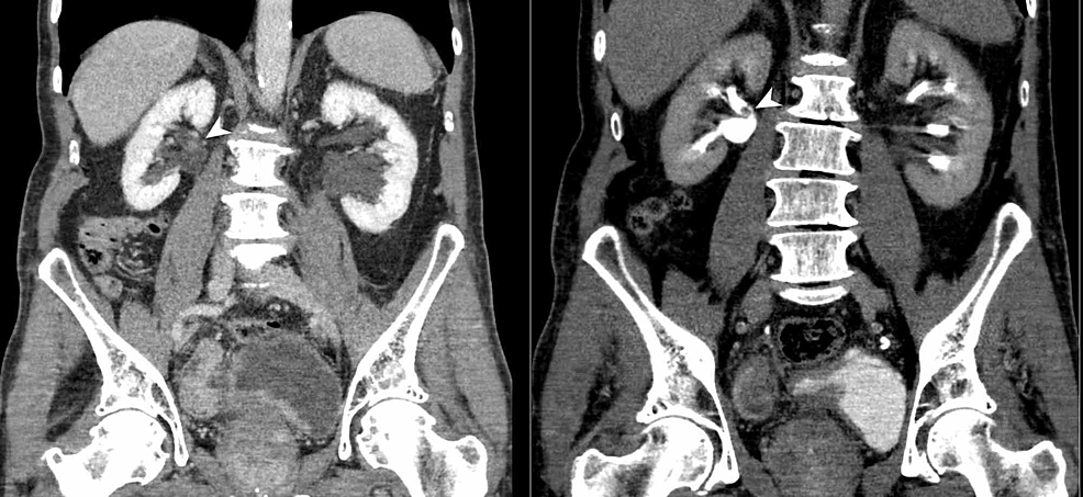 CCT vezical și renal-(CTU)