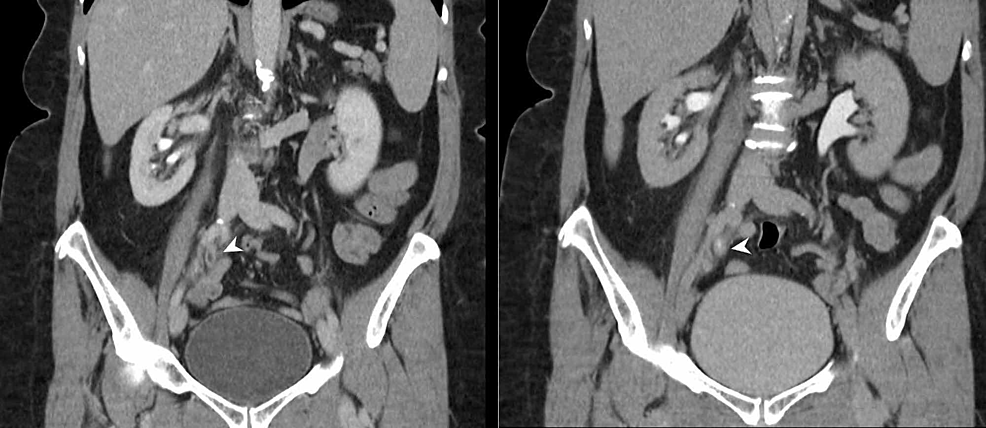 Ureteric-TCC-(CTU)