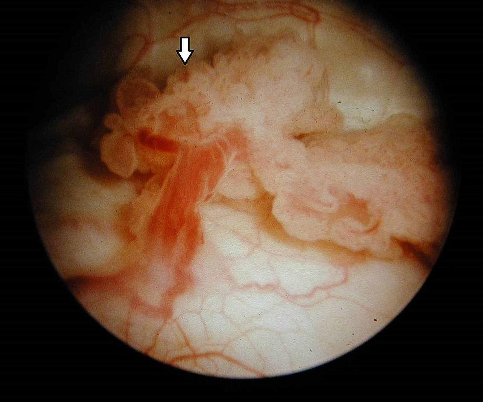 Tumor vezical-(cistoscopie)