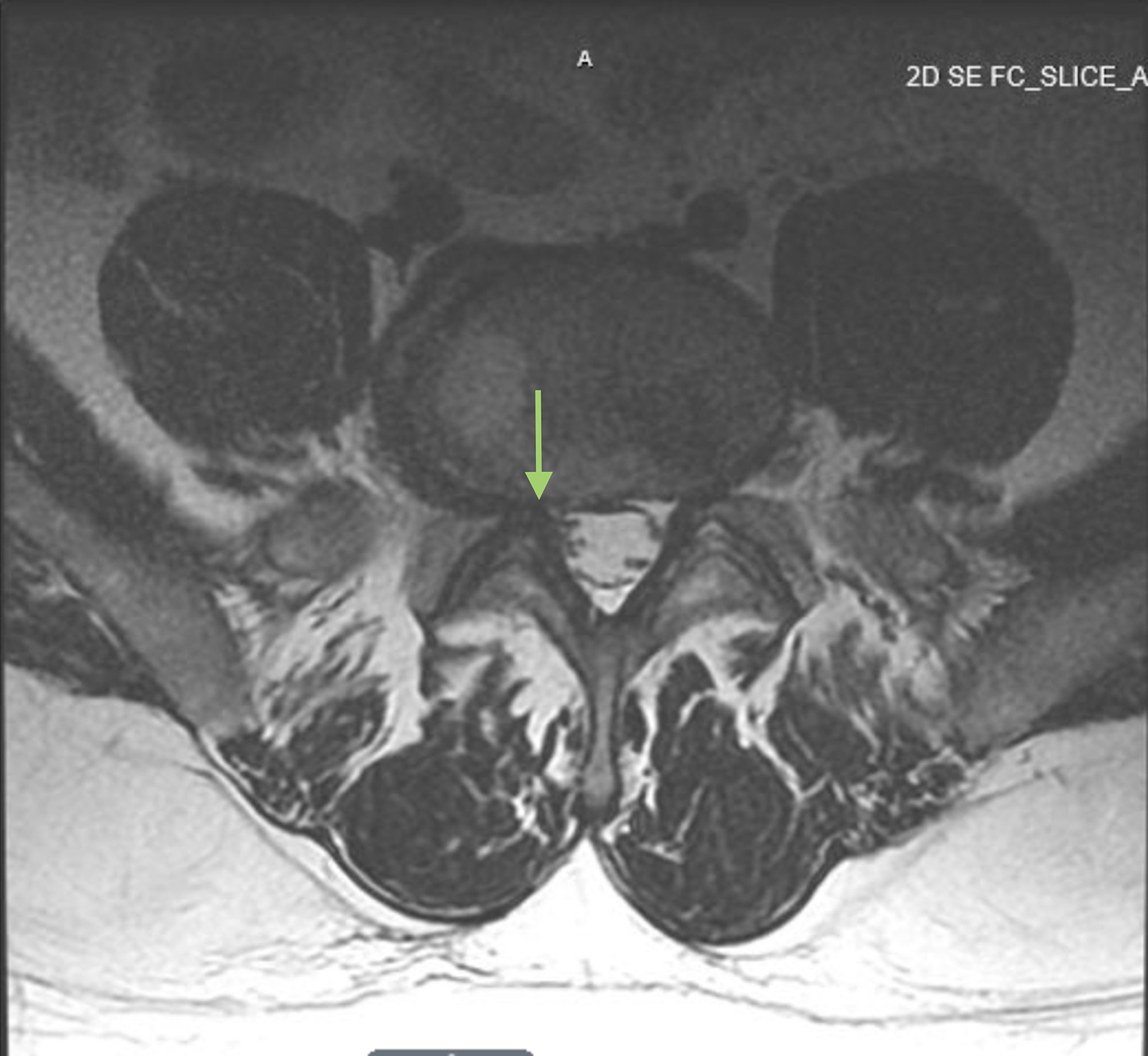 how to read mri images of thoracic spine