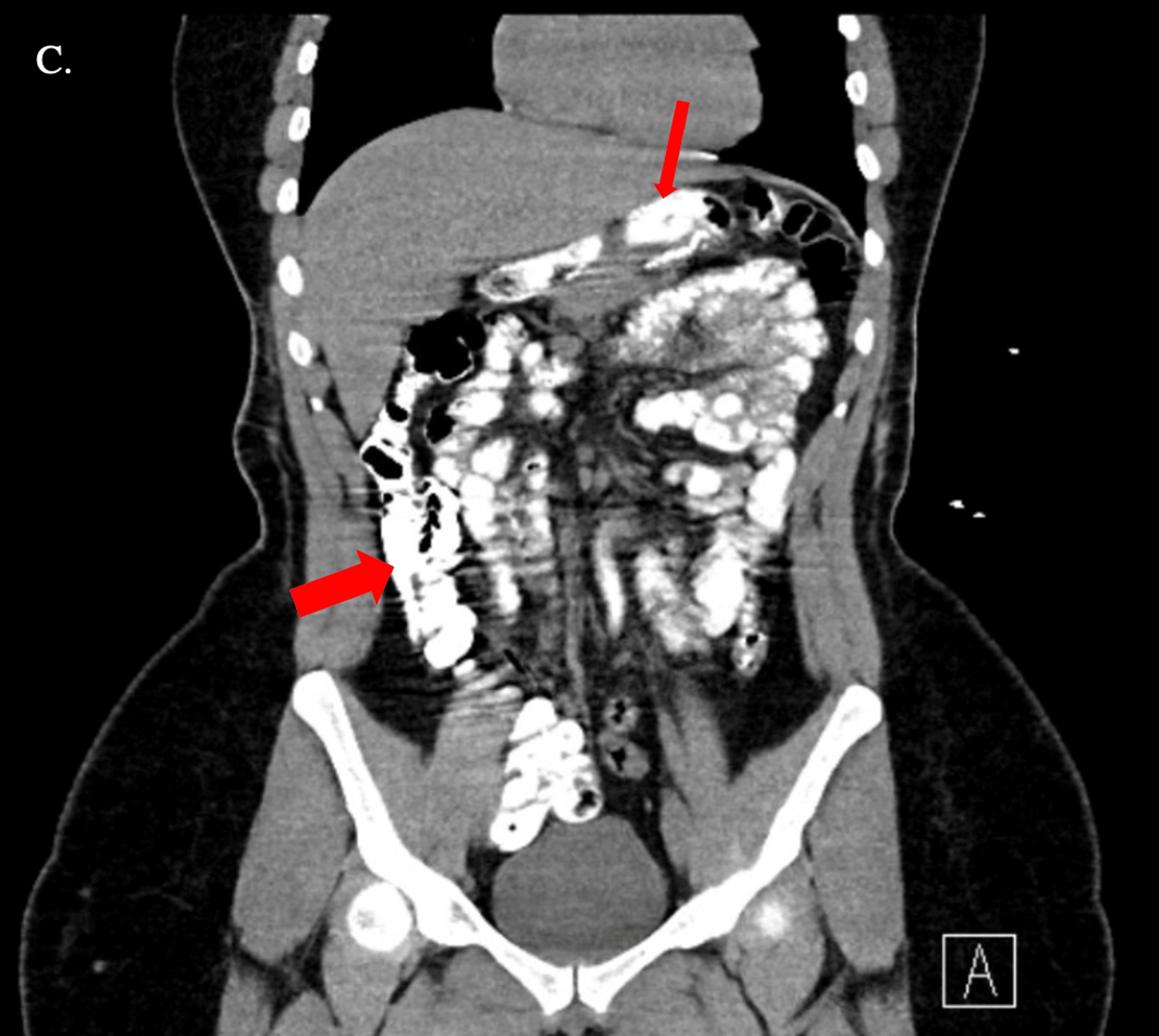 Postoperative Stomach Volvulus and Pancreatitis Following a Sleeve Gastrectomy Cureus
