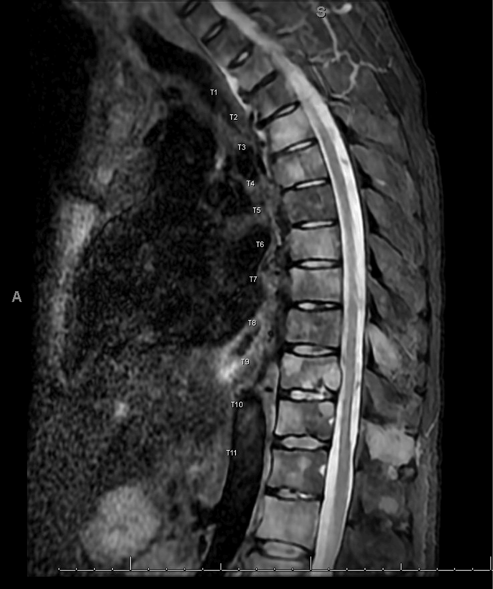 cureus-small-cell-neuroendocrine-prostate-cancer-a-rare-treatment