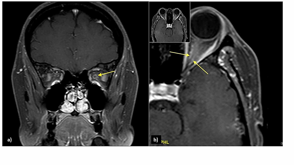Post-contrast-T1-weighted-image-with-fat-suppression-shows:-a)-doughnut-sign-on-coronal-view-(arrow)-and-b)-tram-track-sign-on-axial-view-(arrows)-