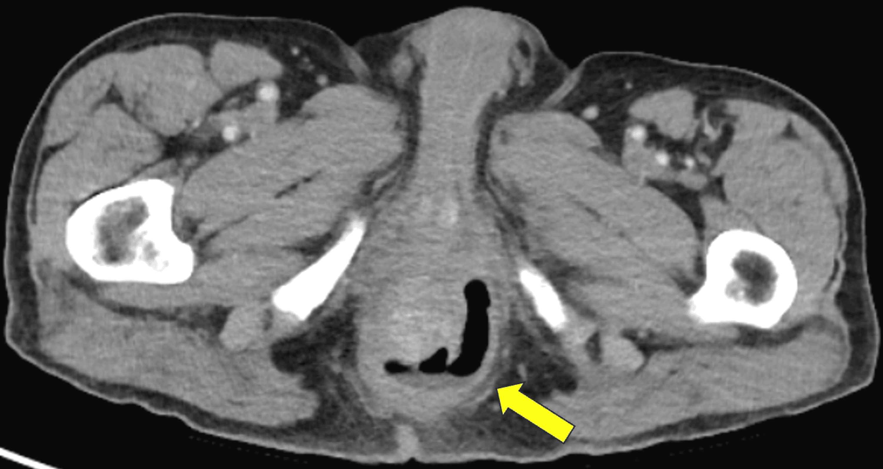 Cureus Horseshoe Abscess as a Rare Complication After Transanal