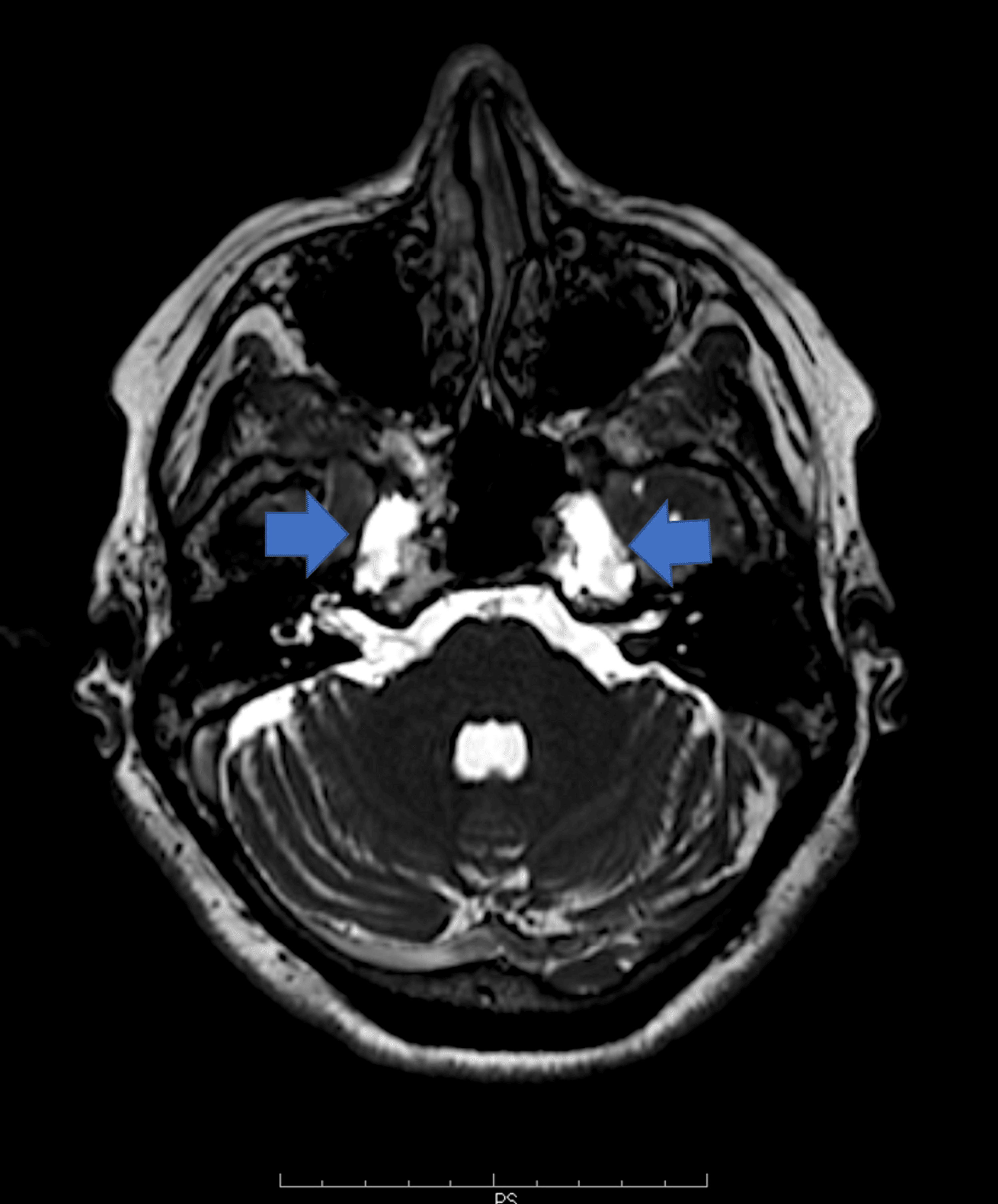 Cureus | Incidental Petrous Apex Cephalocele Presenting With Transient ...