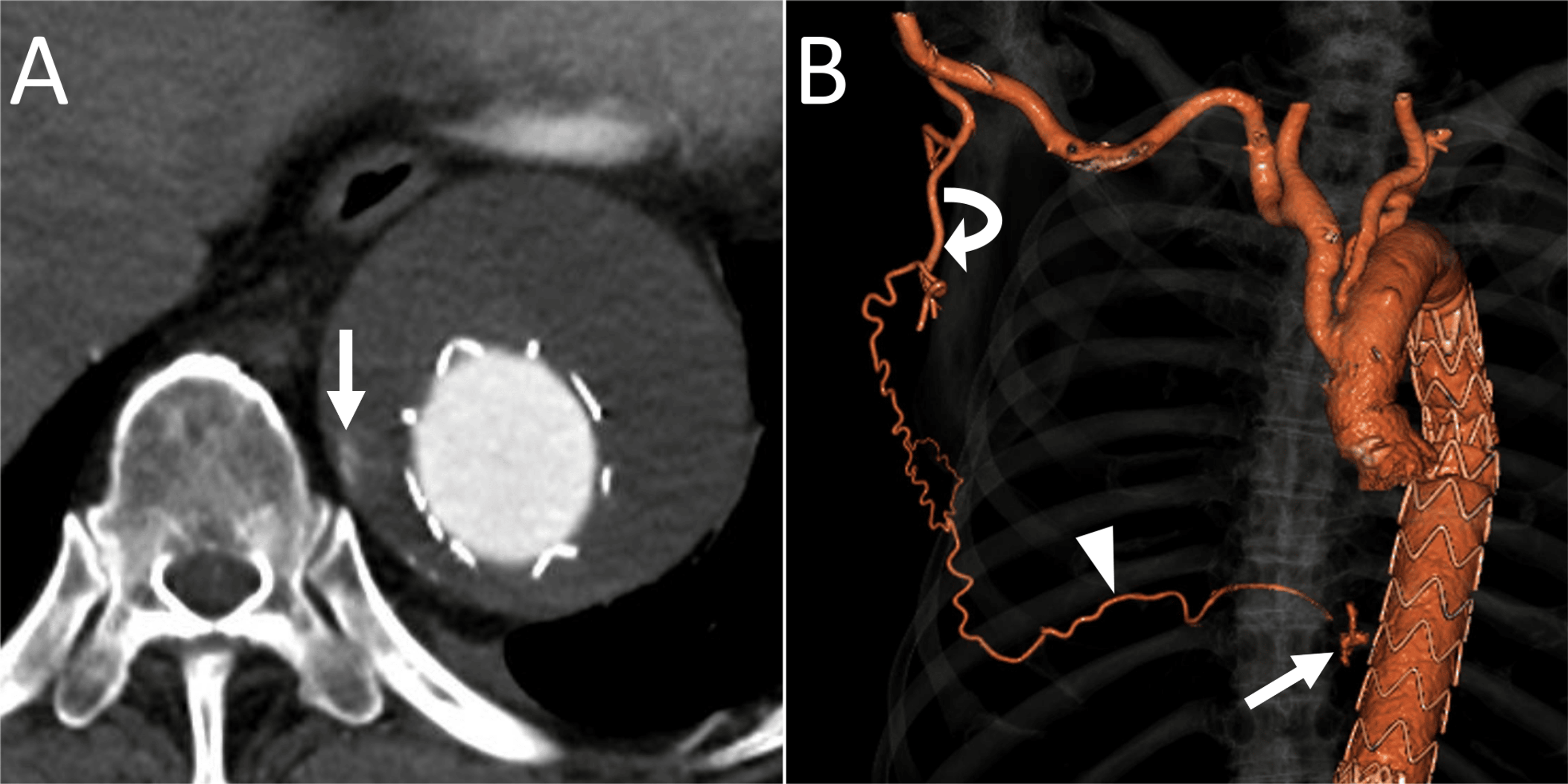 Transarterial Embolization of Type 2 Endoleak Post Thoracic