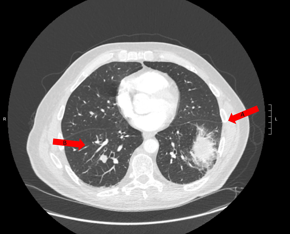 Dapsone-Induced Methemoglobinemia Presenting Concomitantly With COVID ...