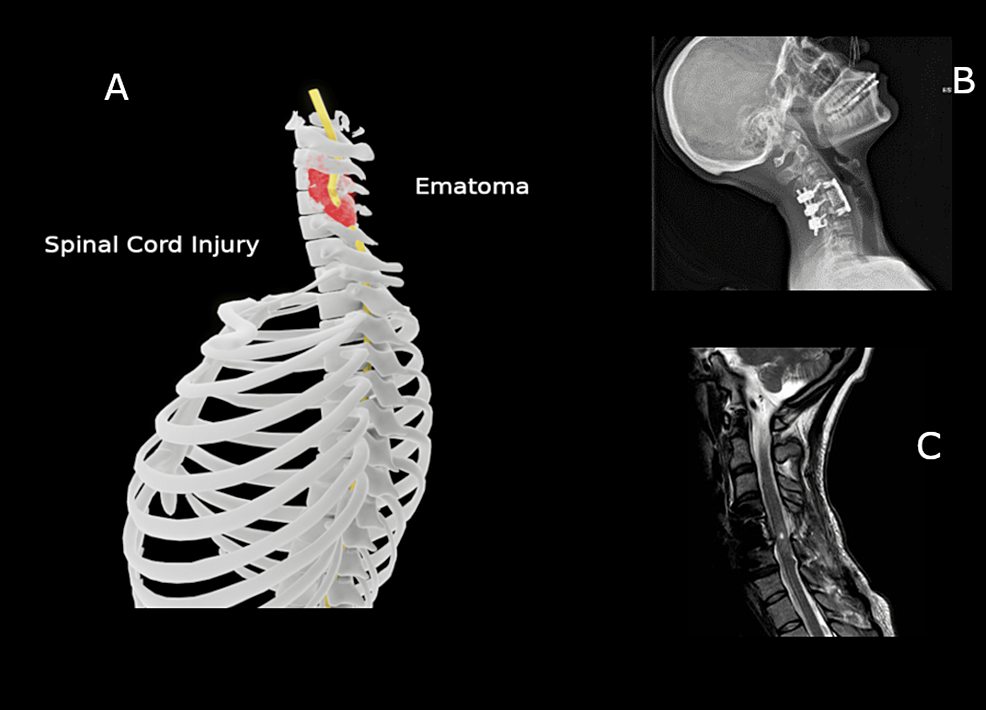Półimmersyjna terapia ruchowa w wirtualnej rzeczywistości w rehabilitacji kończyn górnych u pacjentów po urazie rdzenia kręgowego z wykorzystaniem kontrolera ruchu skokowego