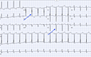 Ischemic Myocardial Positron Emission Tomography Perfusion Without ...