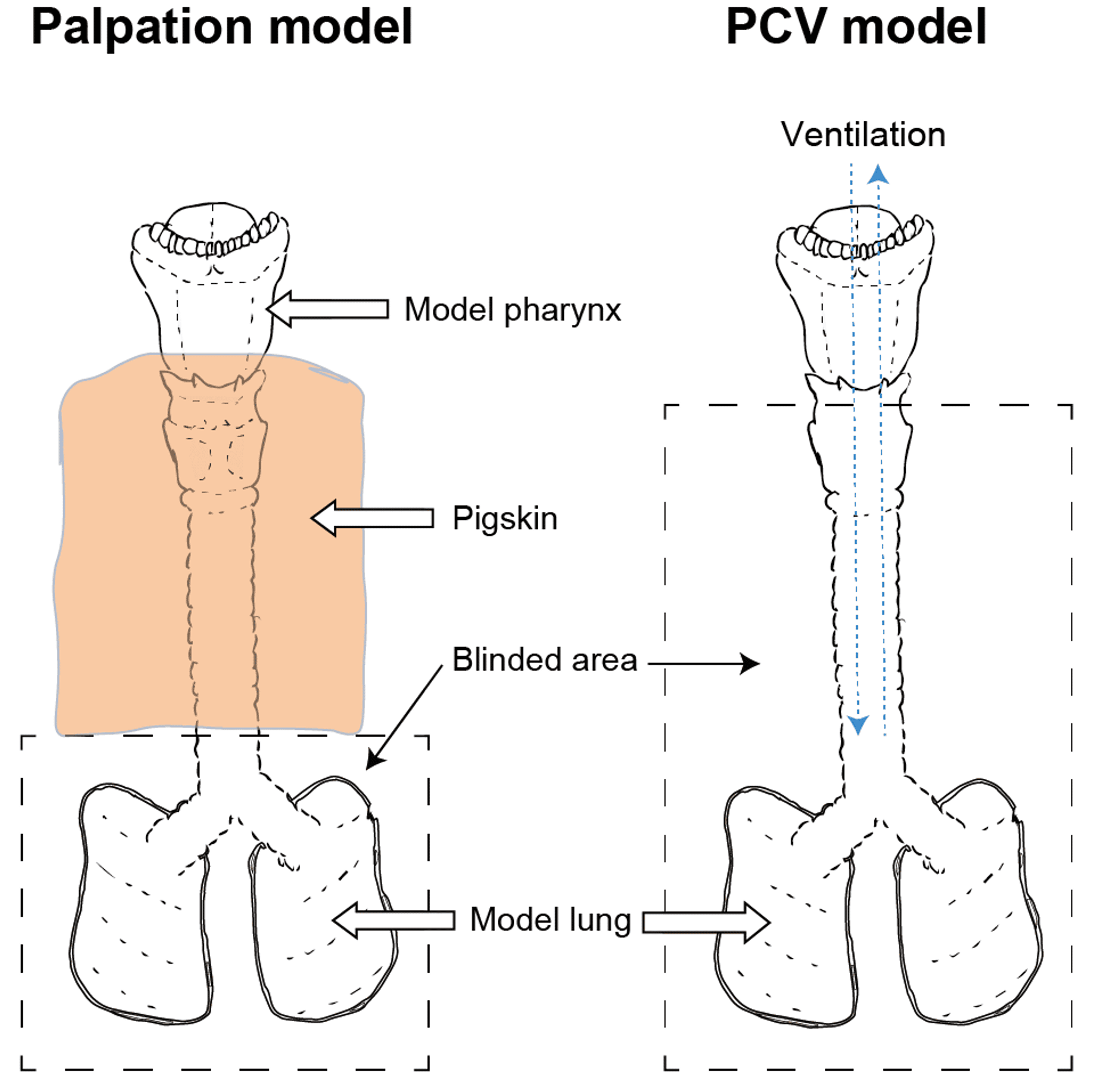 Cureus Comparison of Pressure Control Ventilation and Palpation Methods to Protect the