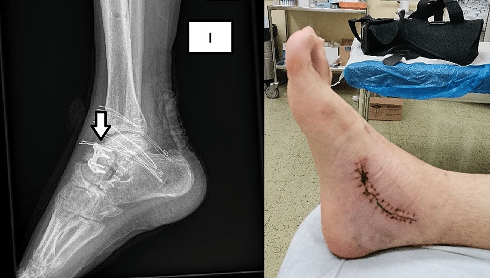 Posttraumatic Cavovarus Deformity Due to a Varus Malunited Talar Neck