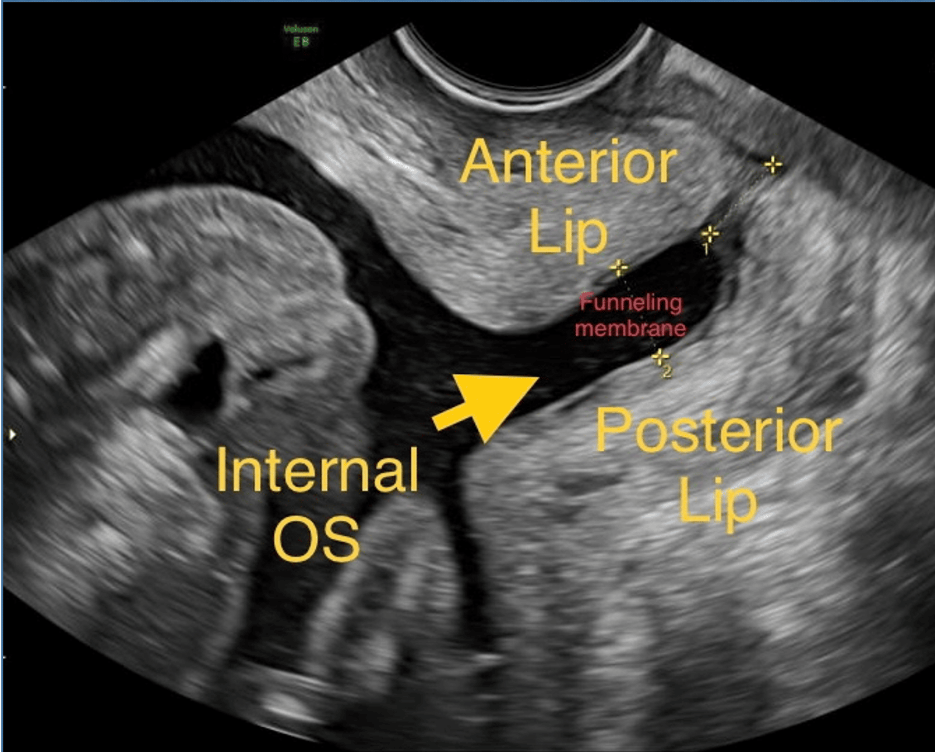 Cureus Rescue Cerclage by McDonald’s Technique at 18 Weeks for