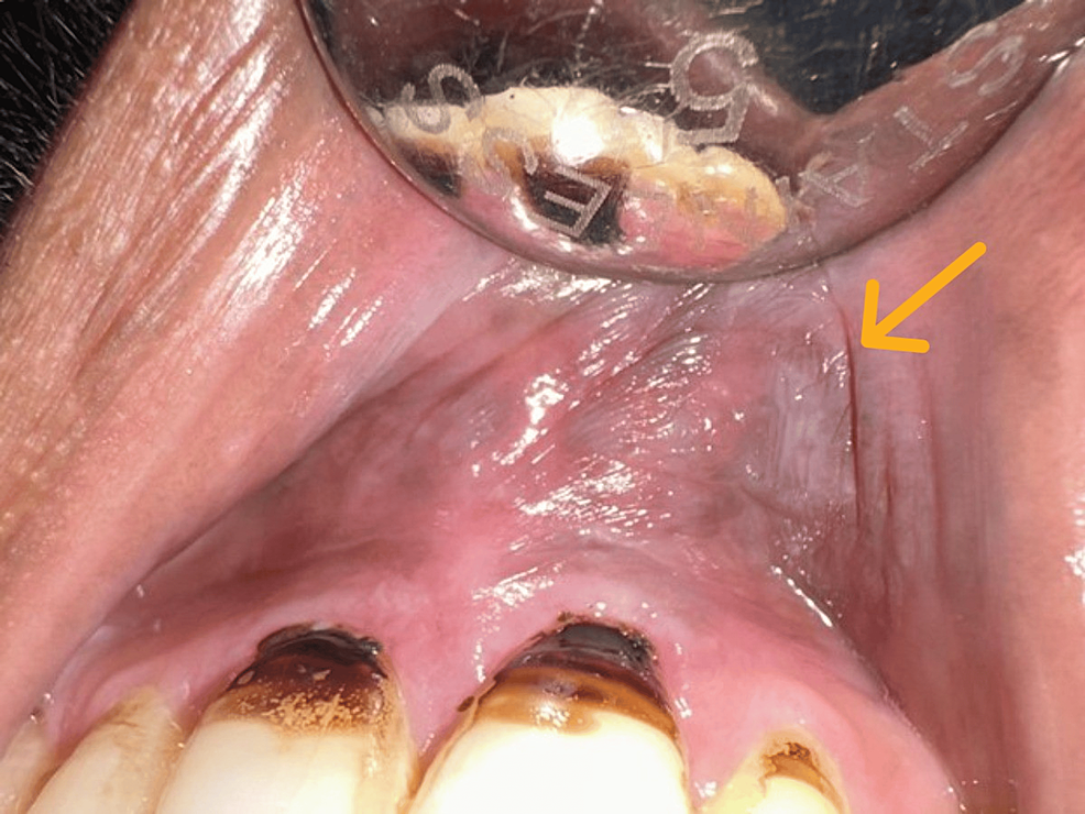 Prevalence of Keratosis in the Oral Cavity A Clinical Retrospective Study Cureus