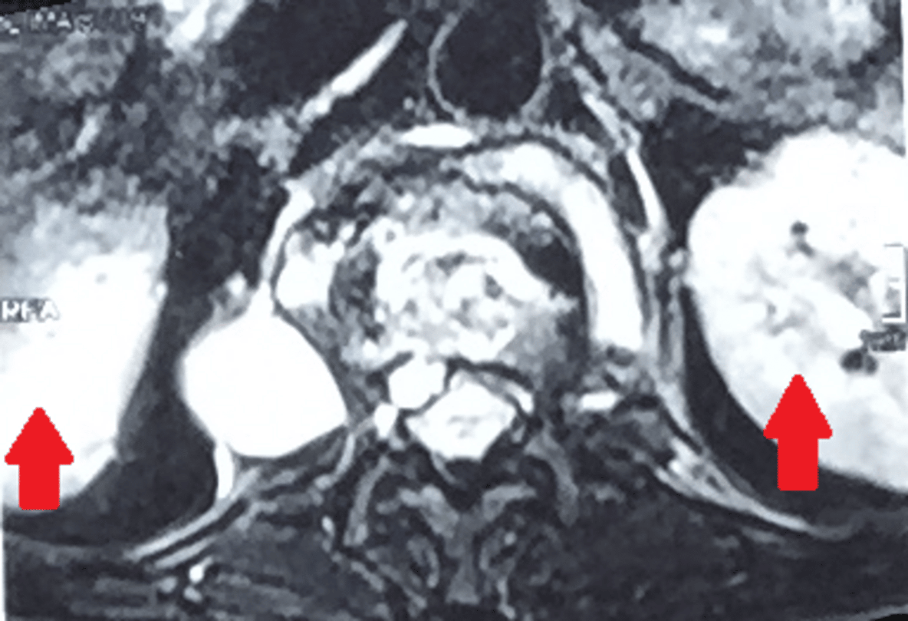 MultidrugResistant Tuberculosis of the Spine With Bilateral Psoas and