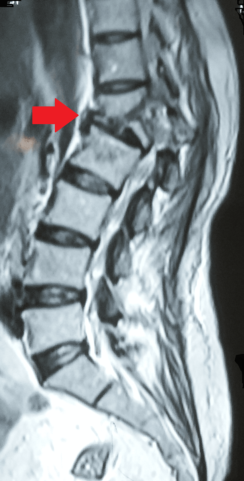 Cureus MultidrugResistant Tuberculosis of the Spine With Bilateral