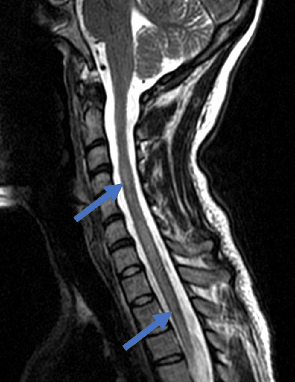 Neurological Manifestion Of Renal Disease