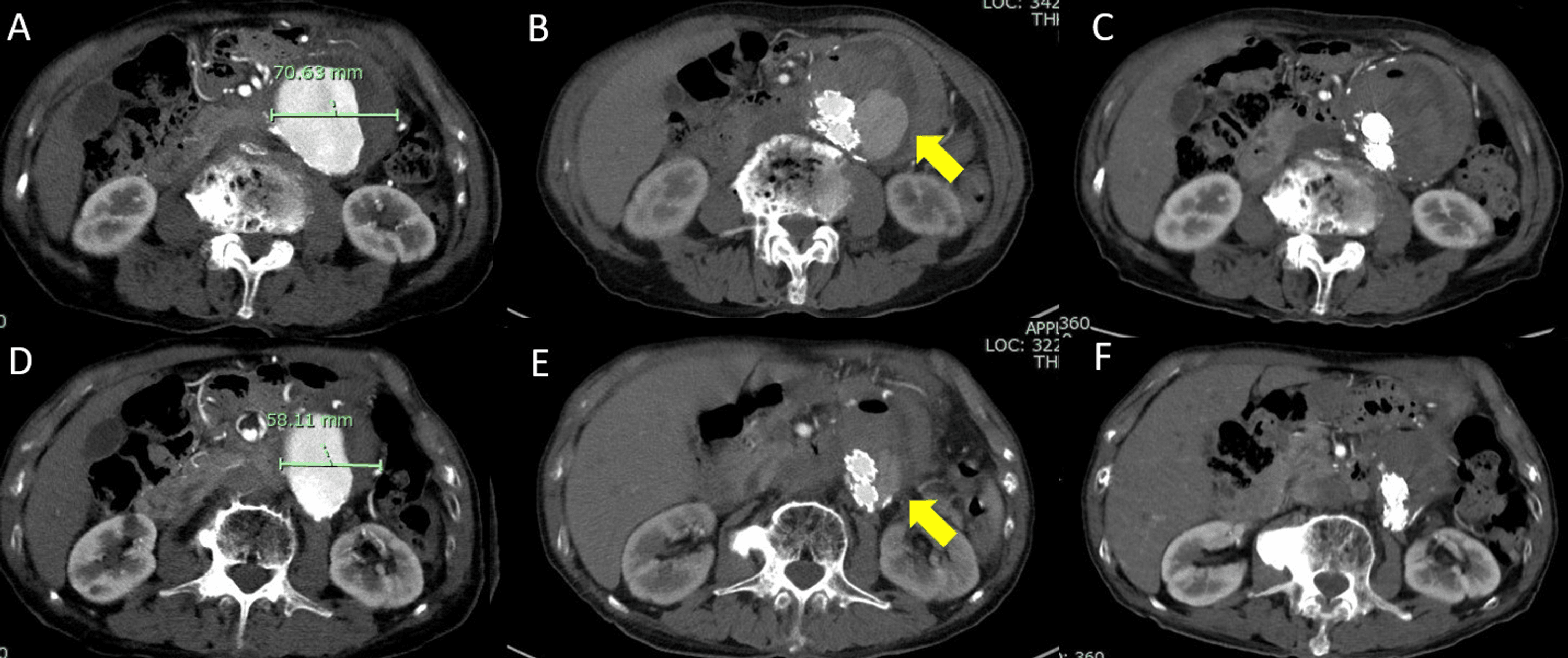 Cureus Diagnosis of Type IV Endoleak After Endovascular Aneurysm Repair Using Visualization