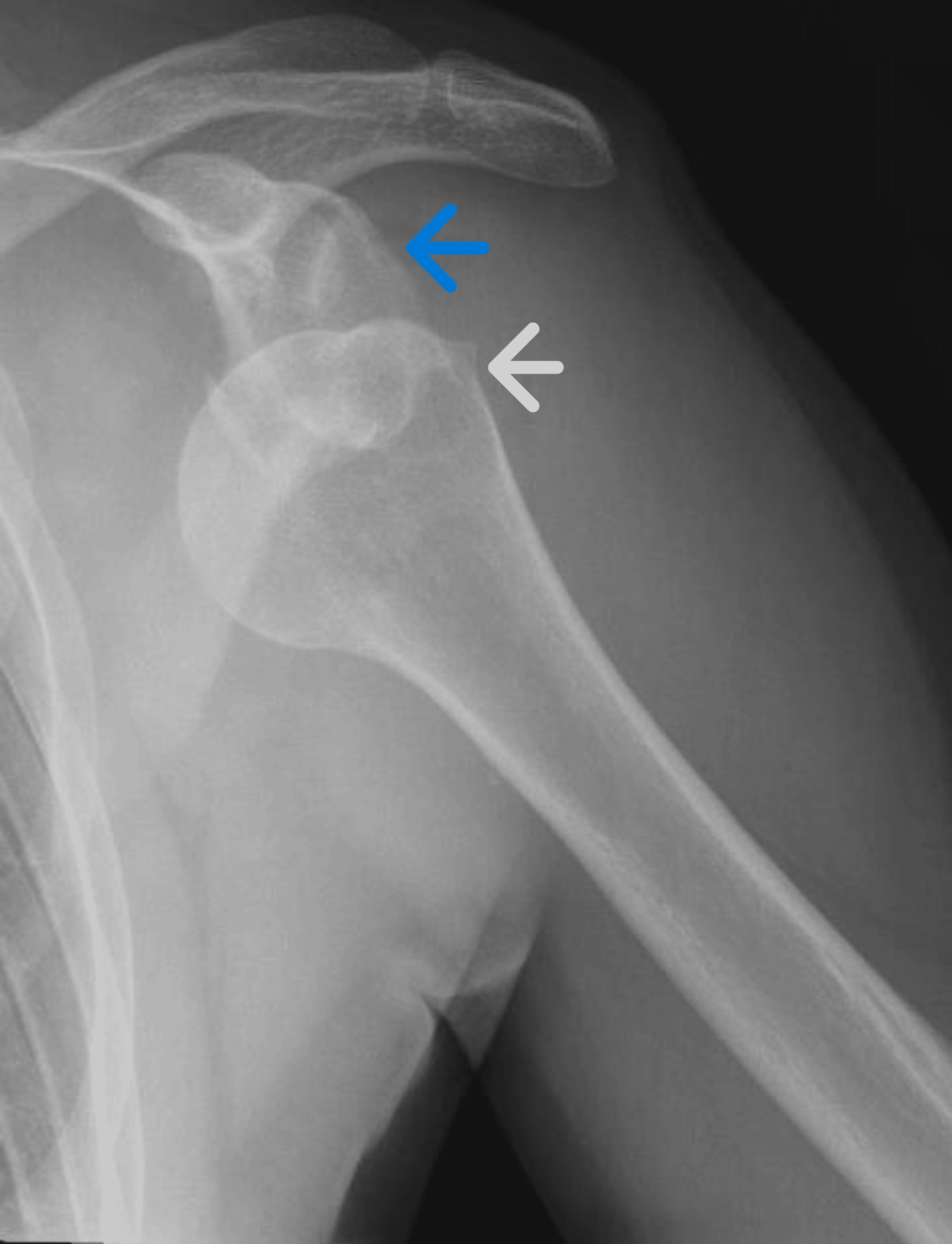 Cureus Use of Handheld Bedside Ultrasound to Confirm Successful