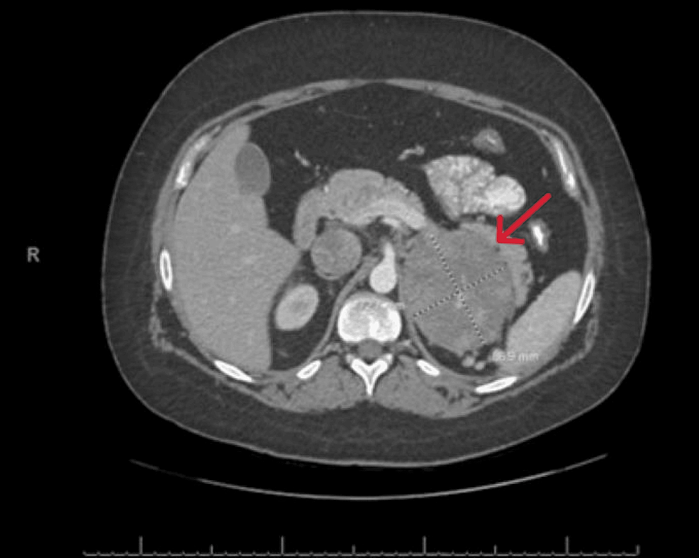 Cureus  A Rare Case of Adrenocortical Carcinoma Manifesting as a