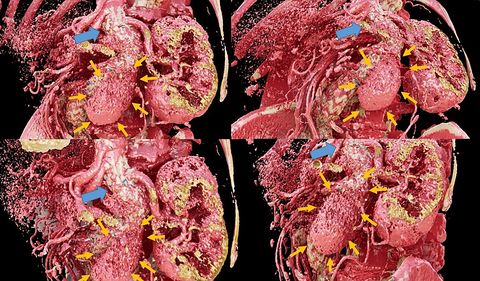 Cureus Diagnosis of Type IV Endoleak After Endovascular Aneurysm Repair Using Visualization
