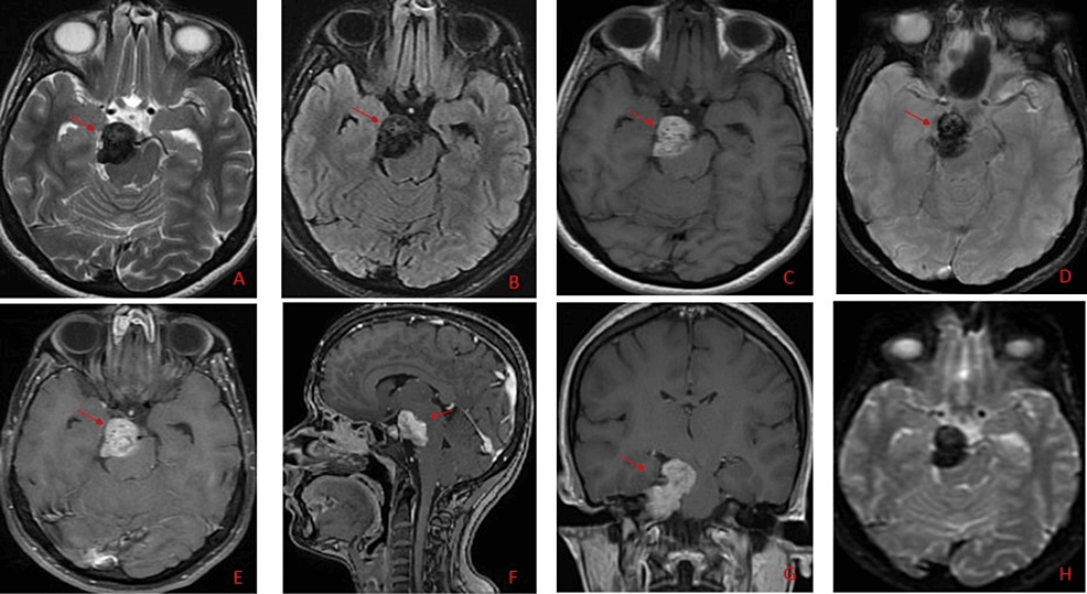 melanotic schwannoma vs melanoma Primary Circumscribed Meningeal Melanoma Involving the Meckel's Cave: A  Report of a Rare Case and Review of Literature
