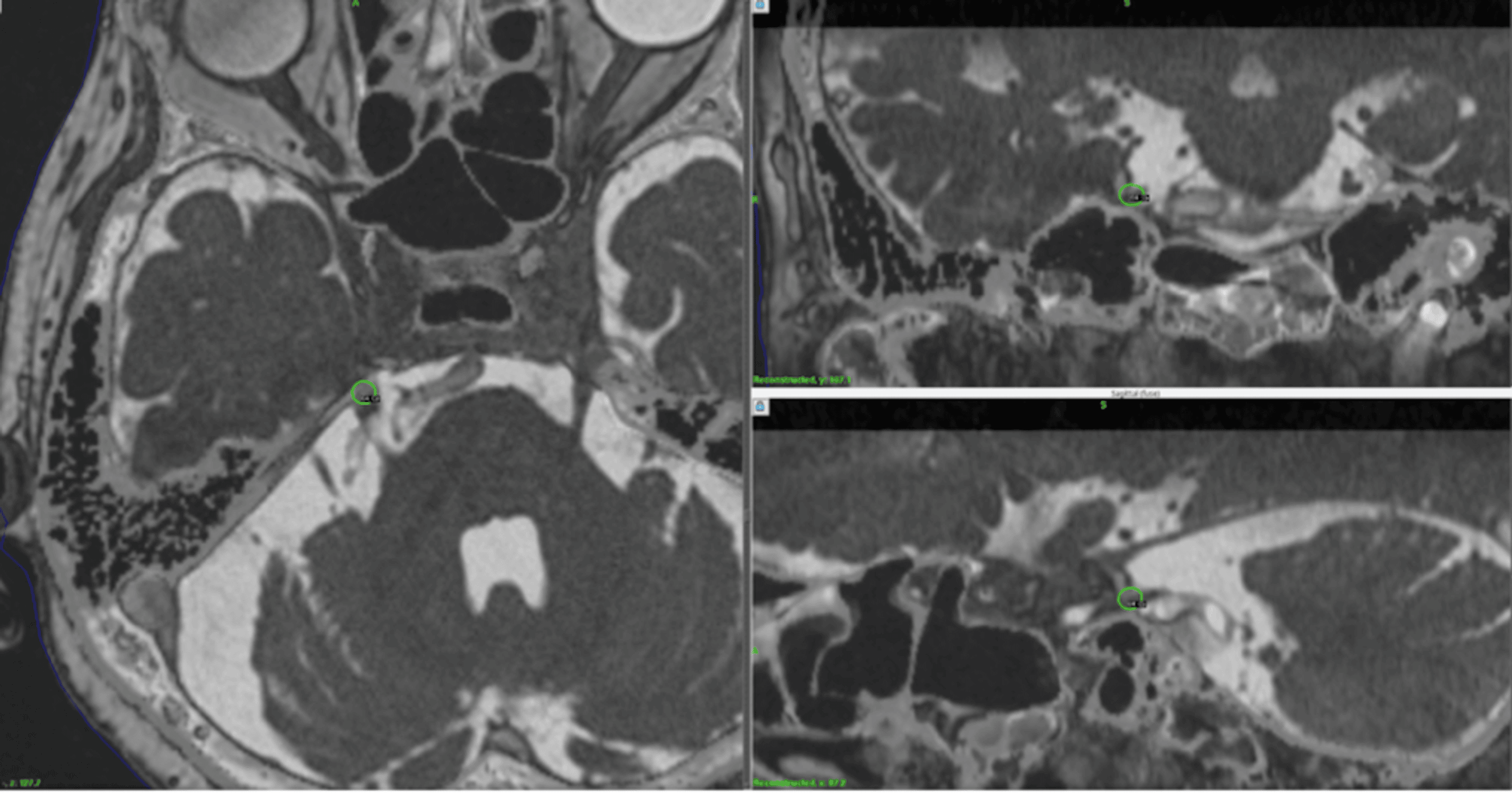 Stereotactic Radiosurgery for Trigeminal Neuralgia Caused by