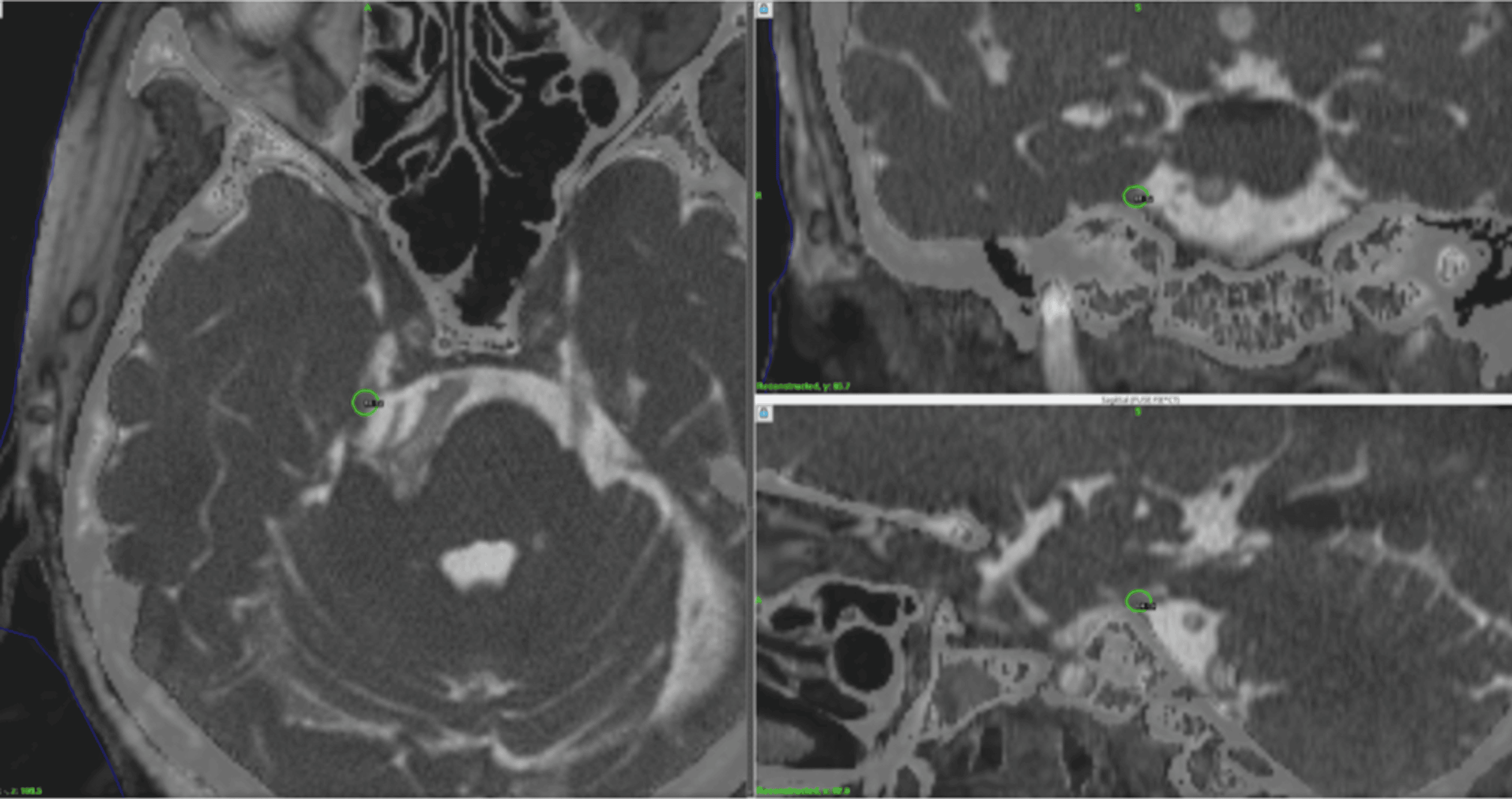Stereotactic Radiosurgery for Trigeminal Neuralgia Caused by Vertebrobasilar Compression A