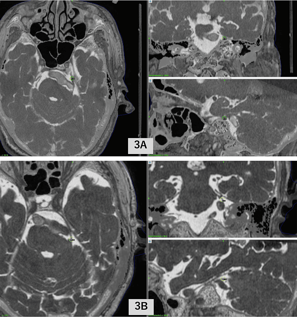Stereotactic Radiosurgery for Trigeminal Neuralgia Caused by
