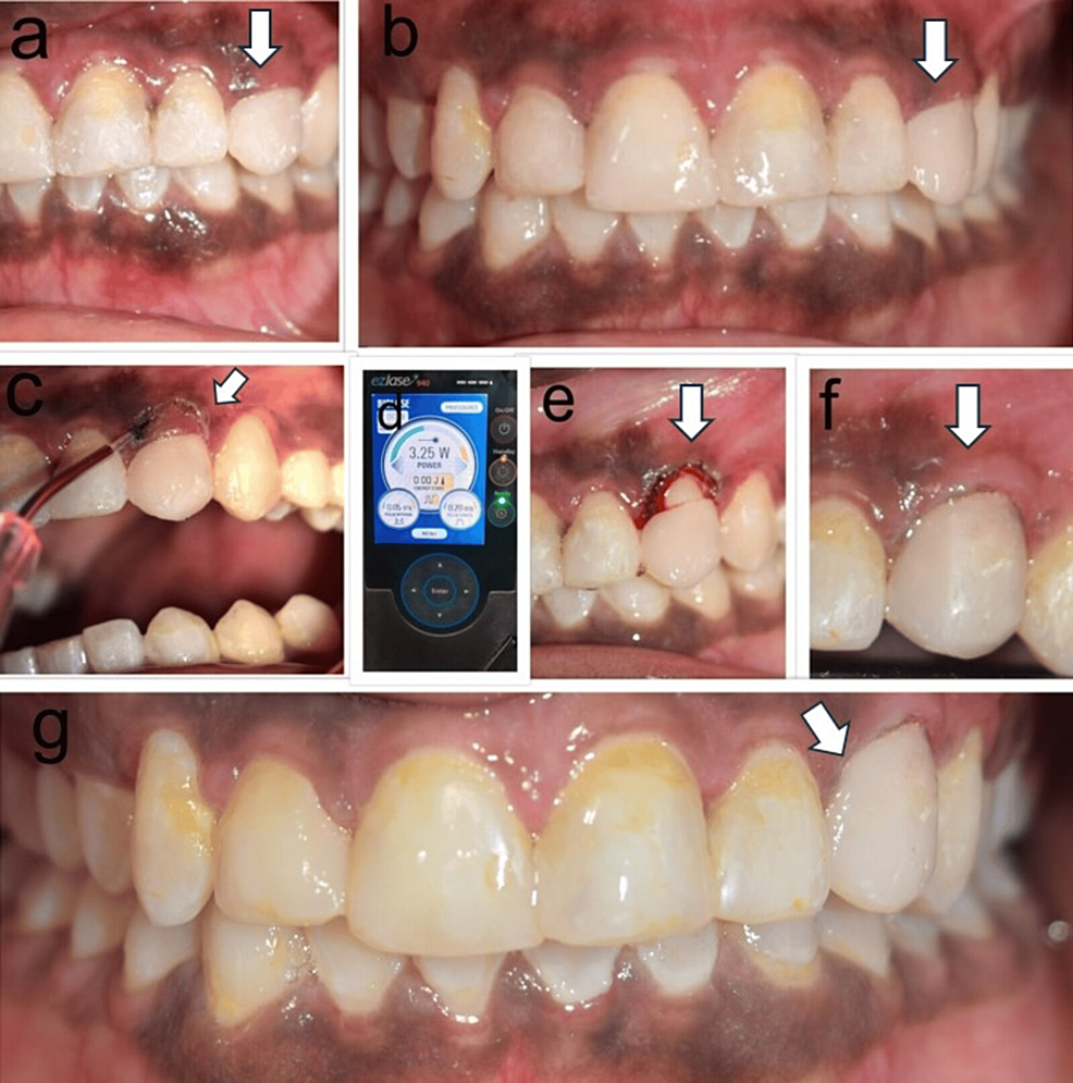 Gingival Zenith Correction by Laser Gingivectomy Cureus