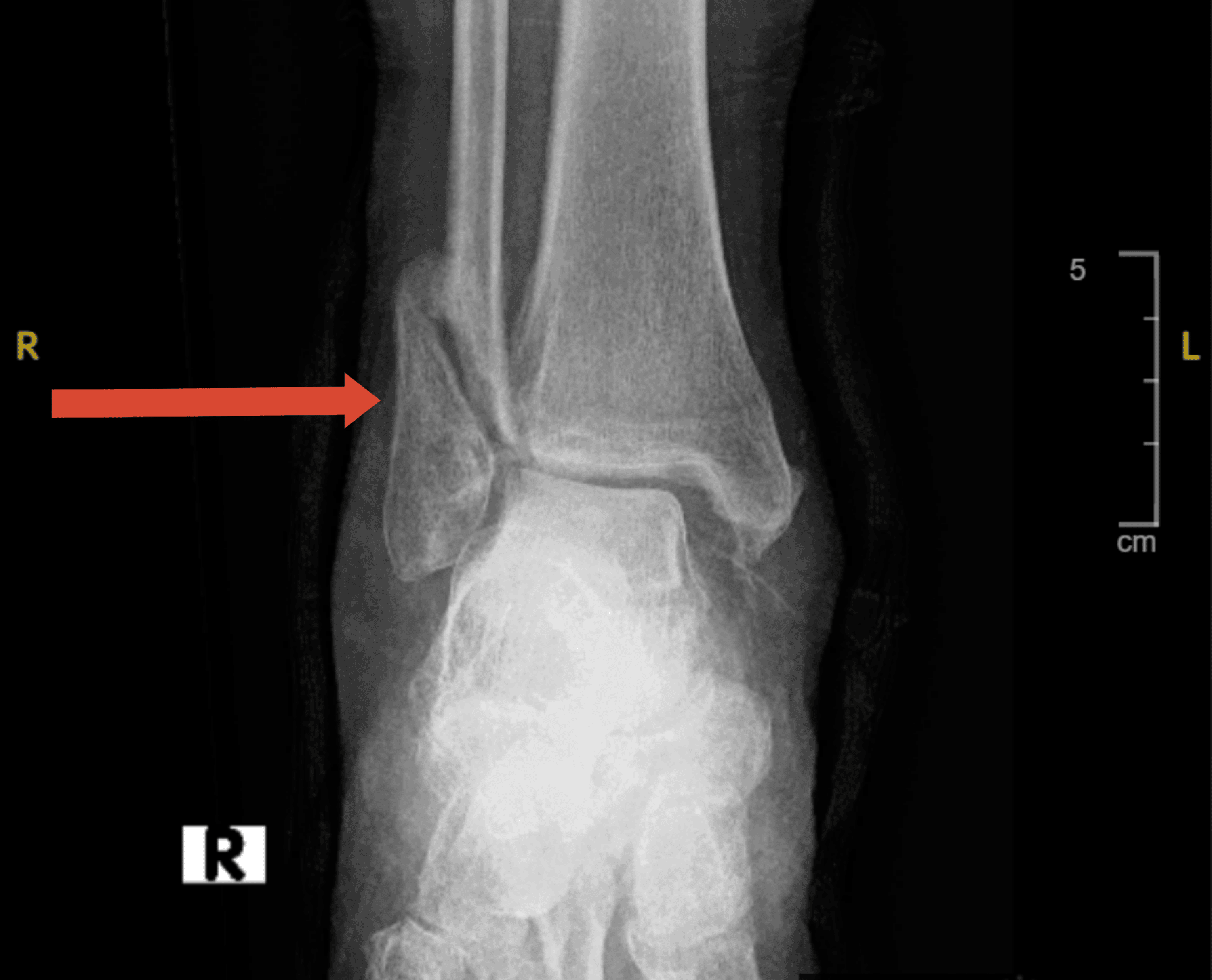 Cureus Electric Shock Sensation and Recurrent Falls as a Side Effect