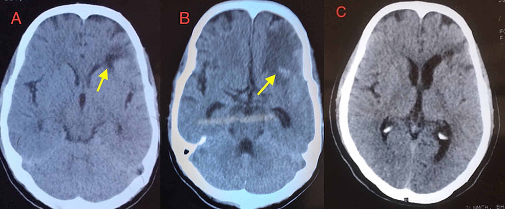 Subtle Cryptococcal Immune Reconstitution Inflammatory Syndrome | Cureus