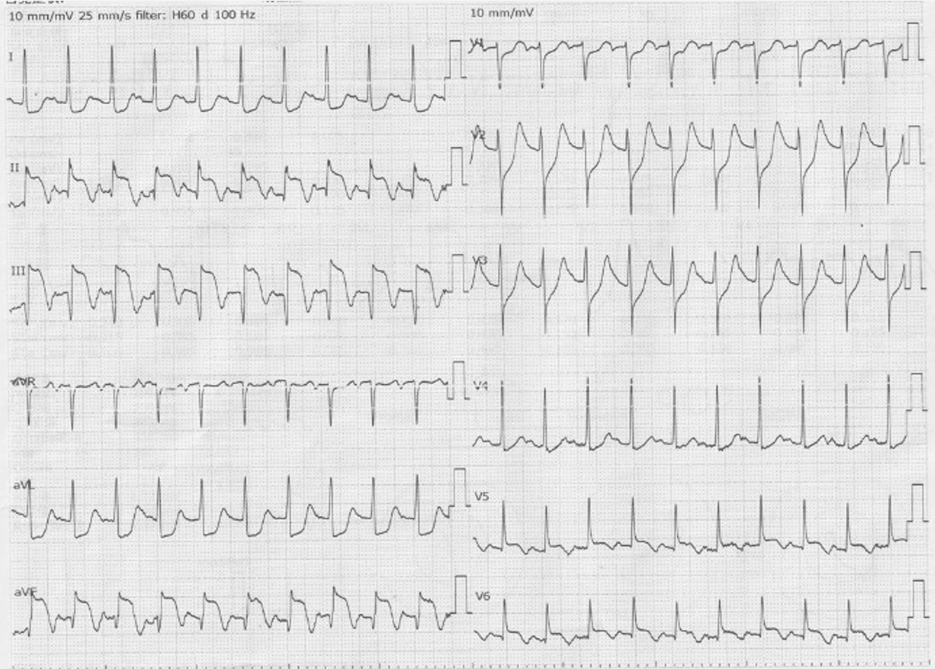 Postinfarction Left Ventricular Free Wall Rupture Diagnosed by ContrastEnhanced Computed