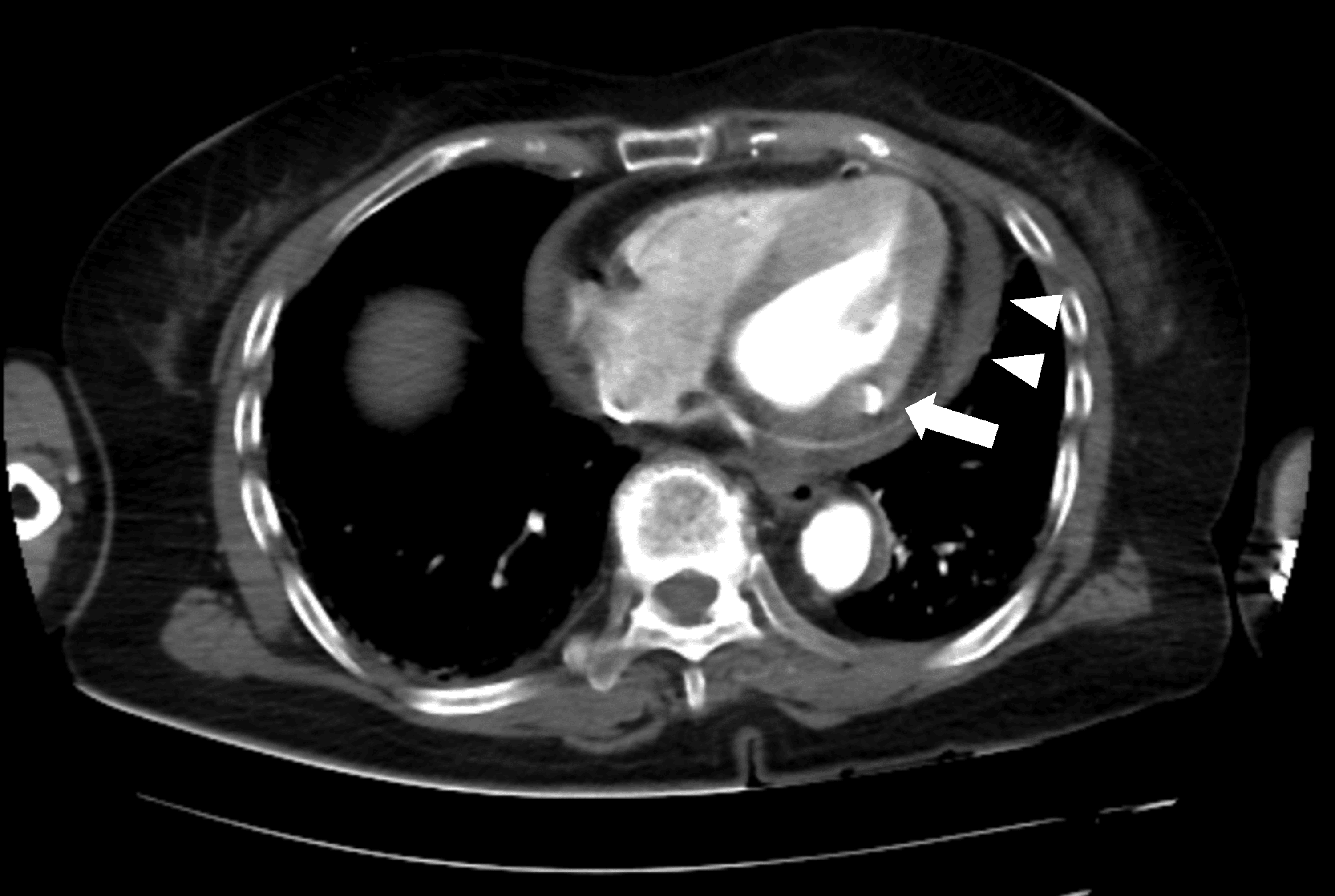 Postinfarction Left Ventricular Free Wall Rupture Diagnosed by ContrastEnhanced Computed