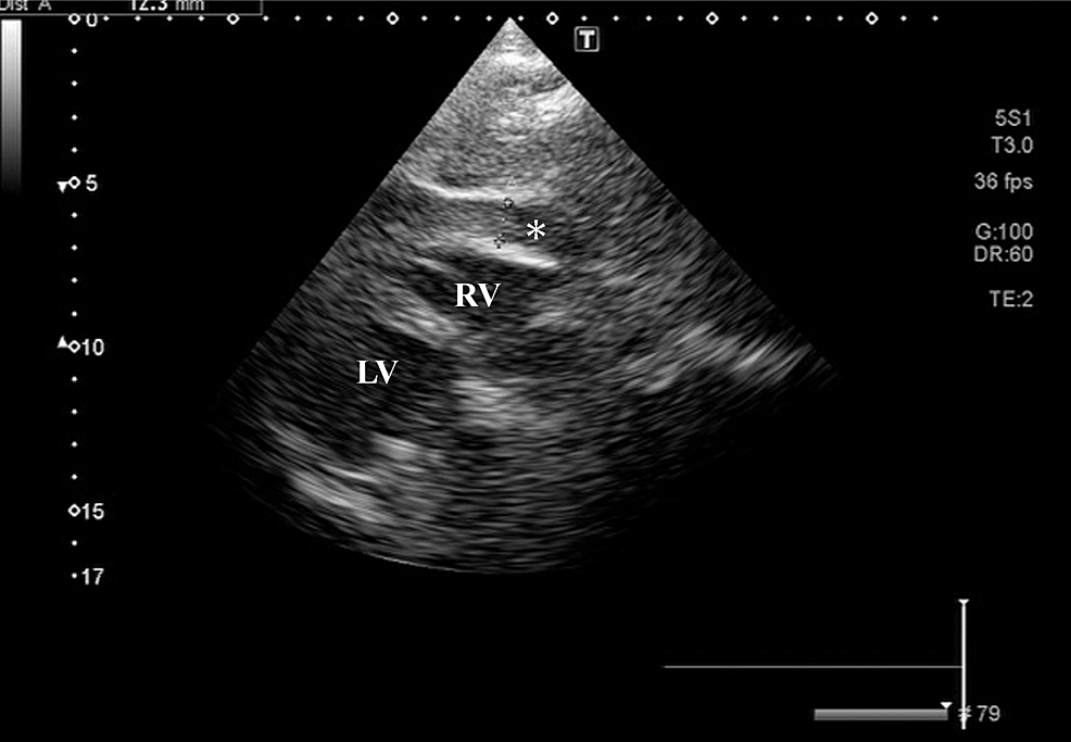 Postinfarction Left Ventricular Free Wall Rupture Diagnosed by ContrastEnhanced Computed