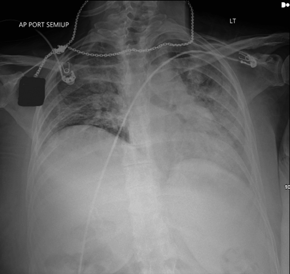 Extracorporeal Membrane Oxygenation